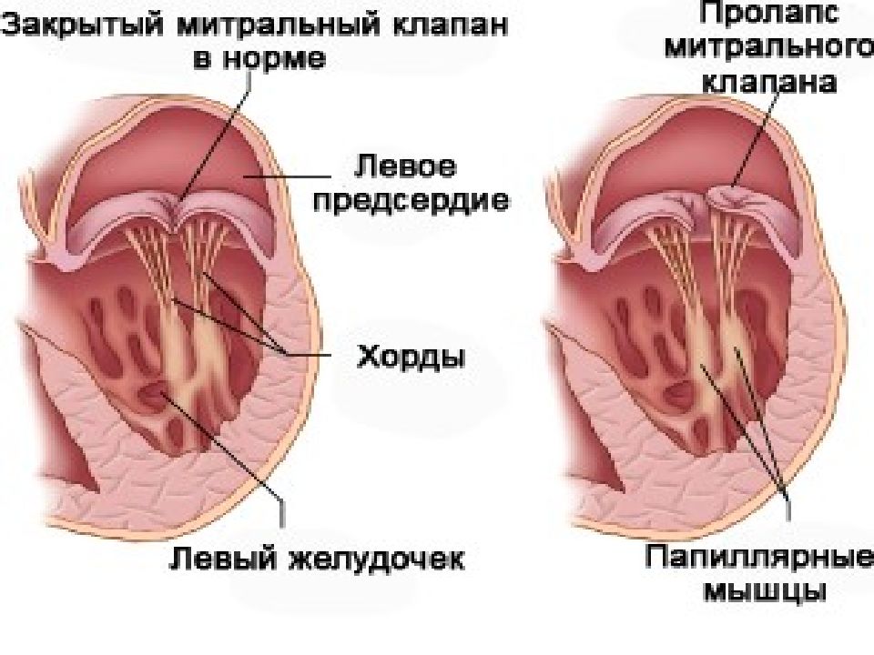 Приобретенные пороки сердца презентации