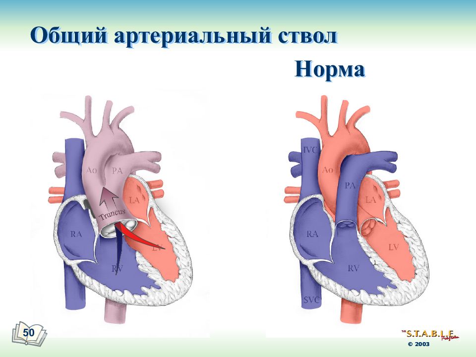 Артериальный ствол. Двухкамерное сердце. Сочетанный аортальный порок сердца. Общий артериальный ствол.