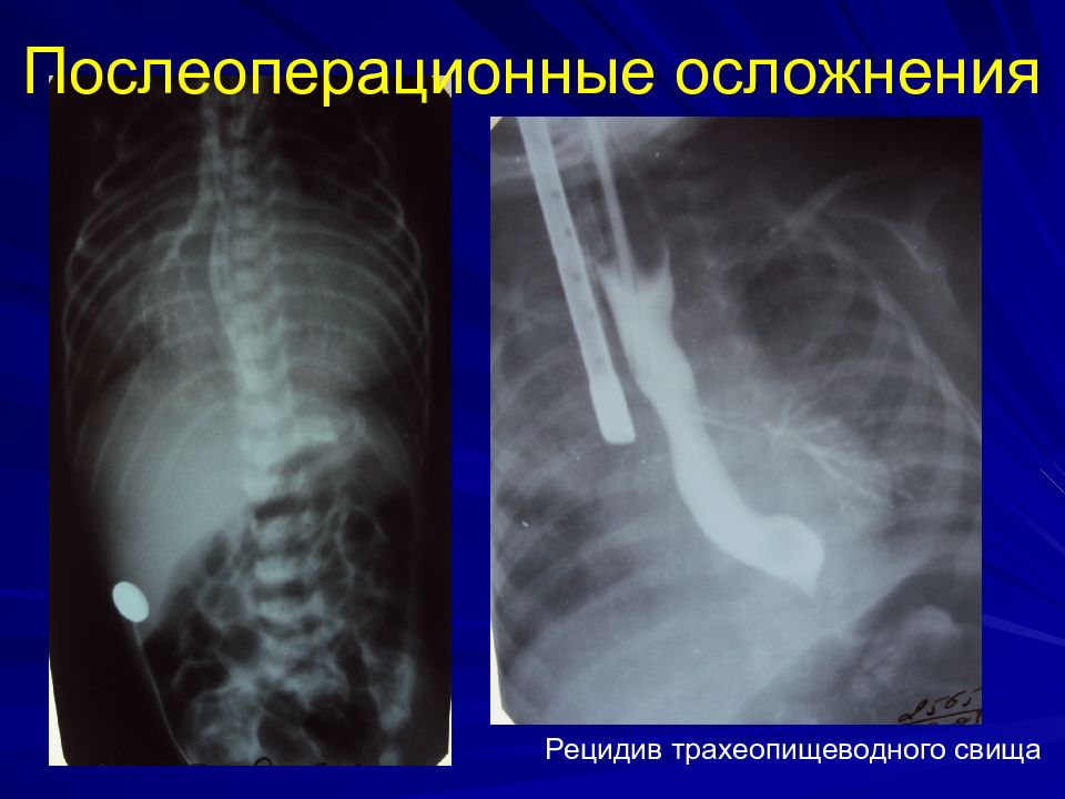 Атрезия пищевода. Трахеопищеводный свищ рентген. Эзофагеальная атрезия. Атрезия пищевода рентгенограмма. Атрезия пищевода презентация.