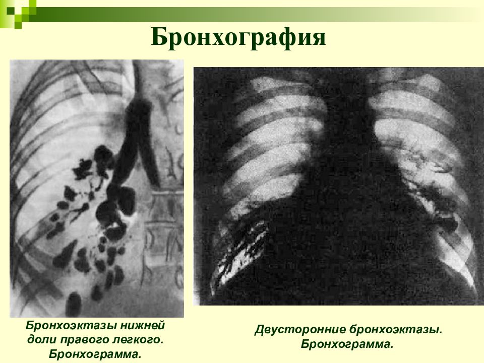 Бронхоэктатическая болезнь презентации