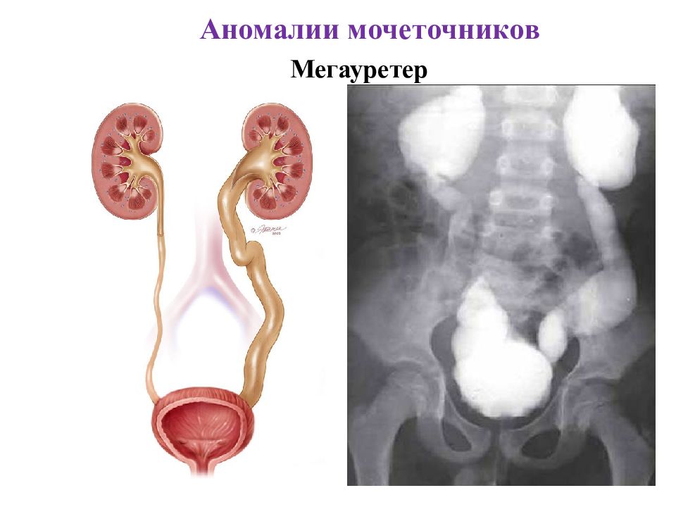 Аномалии мочеполовой системы презентация