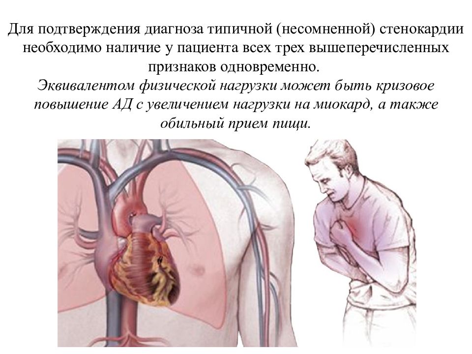 Стенокардия этаж. Осложнения стенокардии.