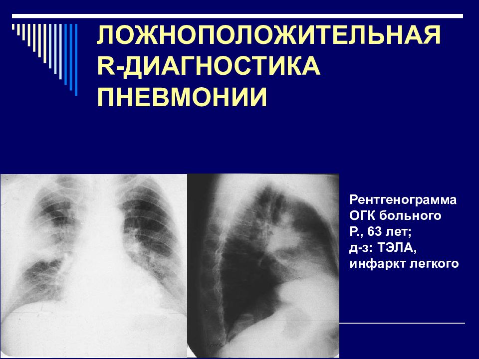 Рентгенологическая картина пневмонии