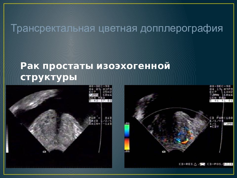 Простаты трансректально. Как делают узи простаты у мужчин.