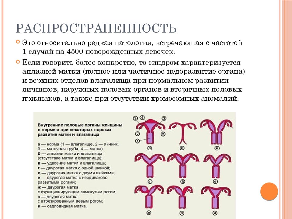 Синдром рокитанского кюстнера майера хаузера. Синдром Майера-Рокитанского-Кюстнера. Синдром Майера — Рокитанского — Кустера — Хаузера.