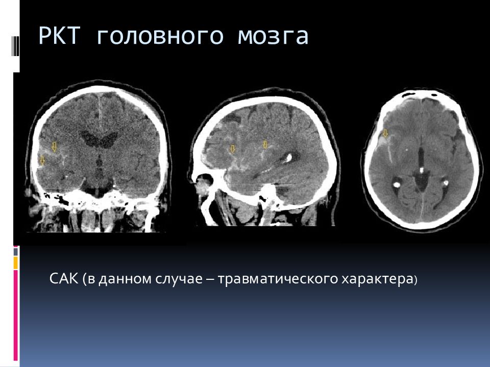 Геморрагический инсульт презентация