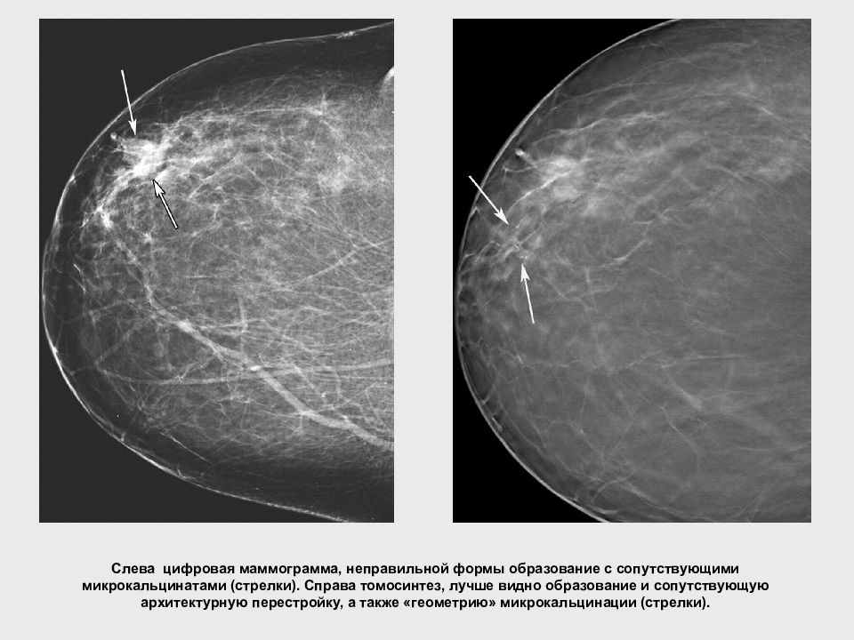Анализ маммографии. Норма молочной железы маммограмма. Фиброаденома молочной железы маммография. Цифровой томосинтез молочной железы. Структура молочной железы маммография.