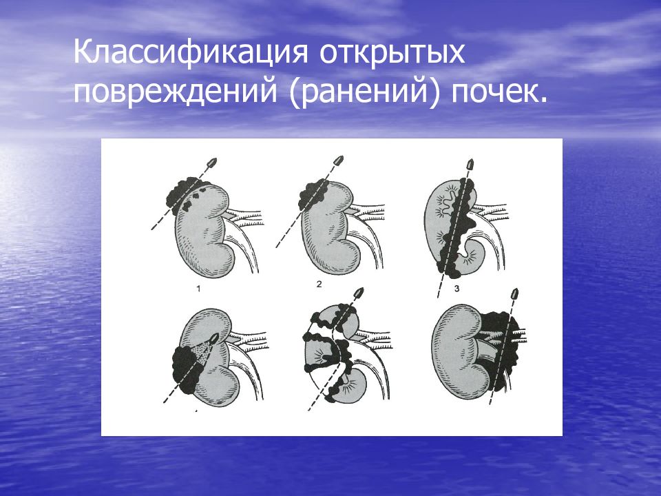 Травмы органов мочевыделительной системы презентация