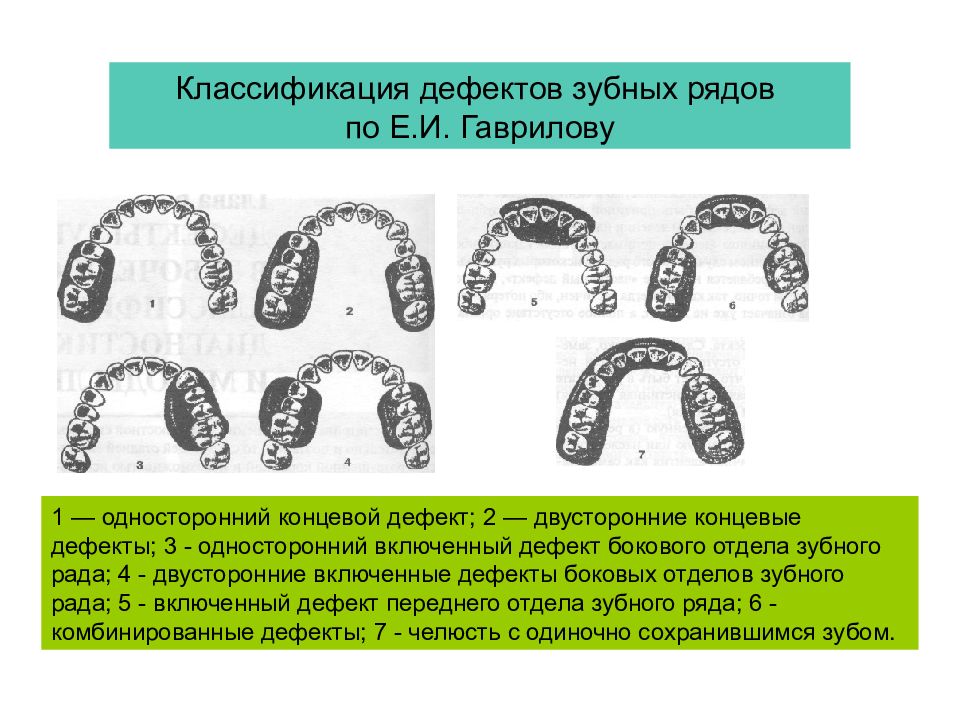 7 дефект. Классификация по Кеннеди и Гаврилову. Классификация дефектов зубных рядов по Кеннеди и Гаврилову. Классификация отсутствия зубов по Кеннеди. Классификация дефектов зуб Гаврилов.