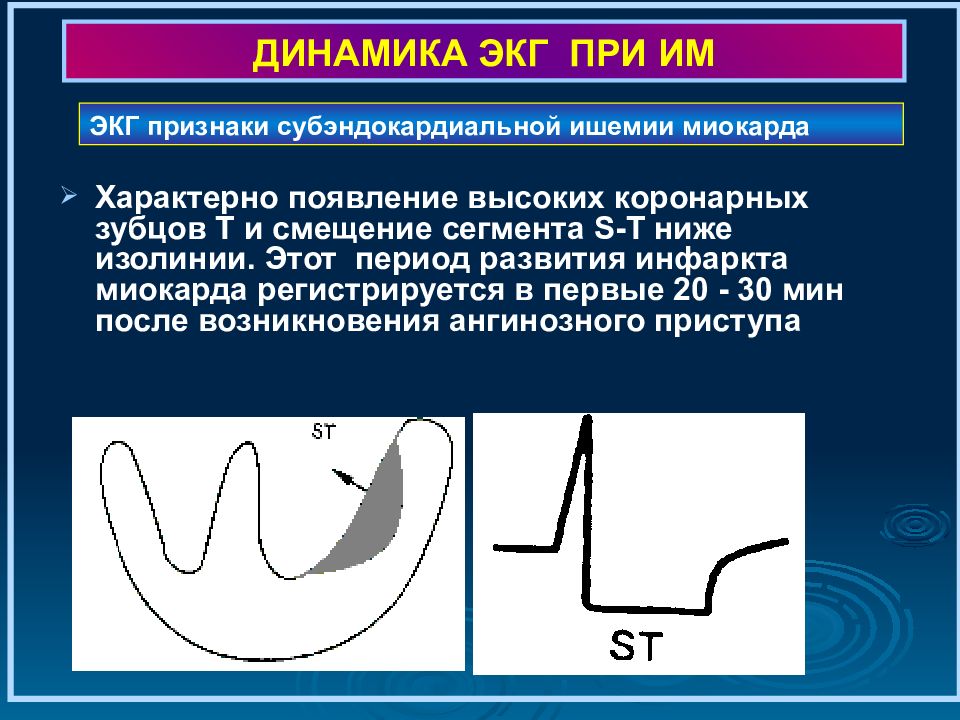 Диагностика инфаркта миокарда картинки