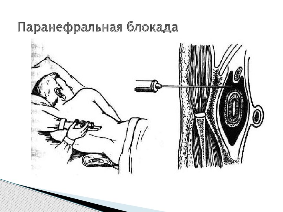 Новокаиновая блокада. Паранефральная блокада по Вишневскому. Паранефральная новокаиновая блокада. Паранефральная блокада техника. Паранефральная новокаиновая блокада показания.