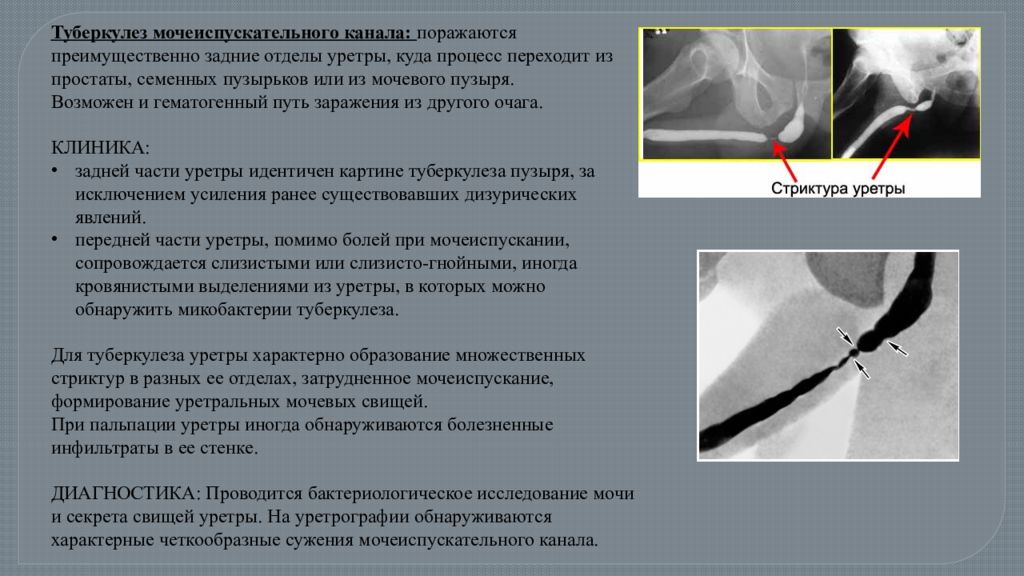 Стриктура уретры. Туберкулез мочеиспускательного канала. Стриктура мочеиспускательного канала. Стриктура уретры симптомы. Диагноз стриктура уретры.