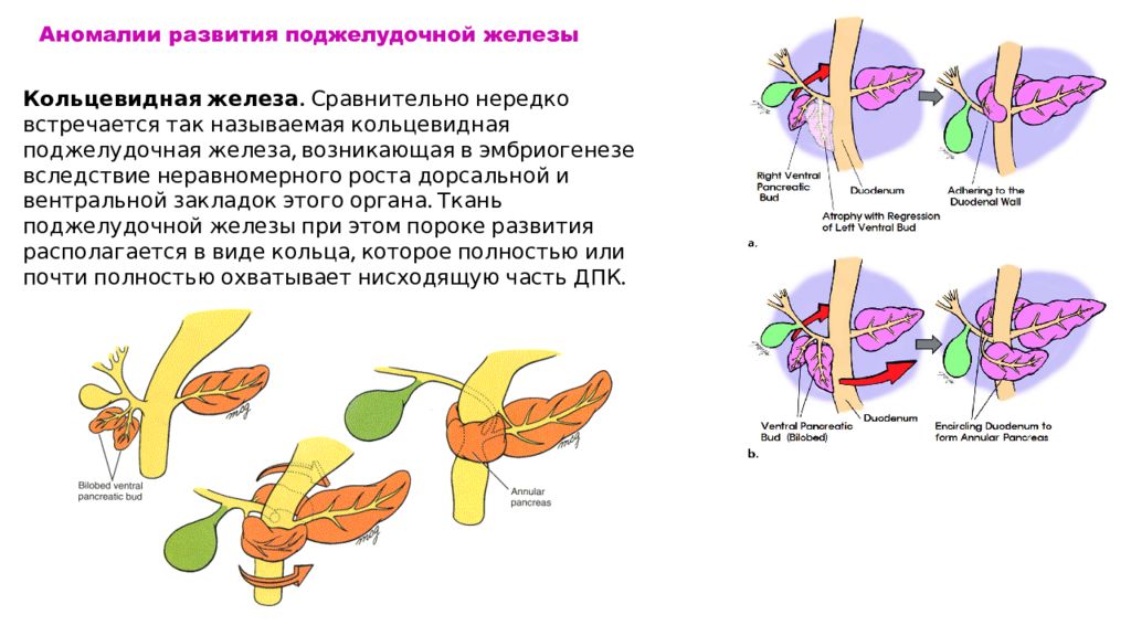 Железы форум. Пороки развития поджелудочной железы. Кольцевидная поджелудочная железа. Аномалии поджелудочной железы. Патология развития поджелудочной железы.