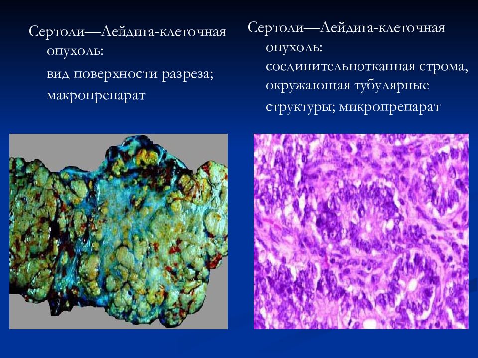 Феминизирующие опухоли яичников презентация