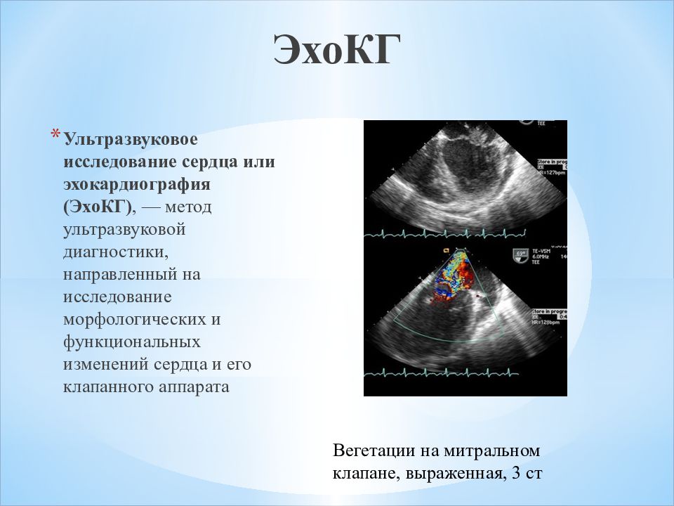 Узи сердца схема