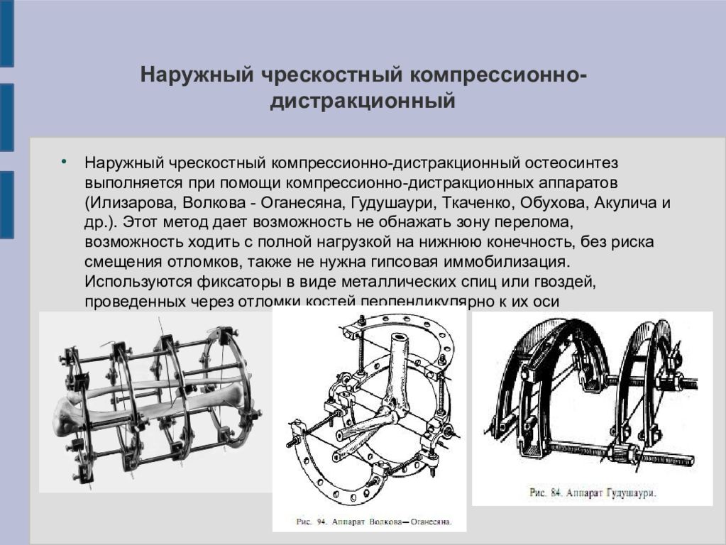 Внеочаговый остеосинтез аппаратом илизарова. Остеосинтез • чрескостный остеосинтез. Внеочаговый (компрессионно-дистракционный, чрескостный) остеосинтез. Внеочаговый компрессионно-дистракционный остеосинтез. Внеочаговый чрескостный остеосинтез.