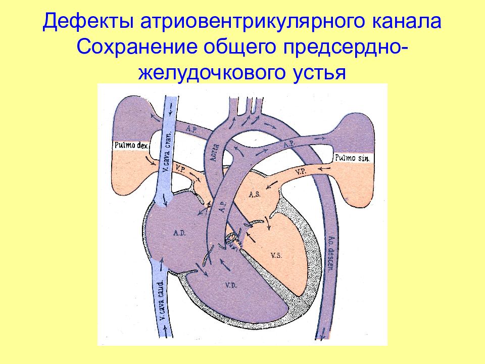 Открытый атриовентрикулярный канал презентация