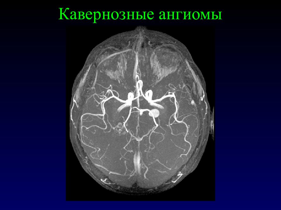 Признаки венозной ангиомы. Голова медузы венозная ангиома. Кавернозная ангиома височной доли.