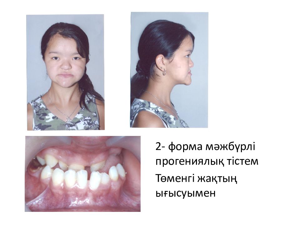 Прогения нижней. Мезиальный прикус (прогенический прикус). Дистальный прикус верхняя прогнатия. Мезиальный прикус логопедия. Дистальный прикус ретрузия.