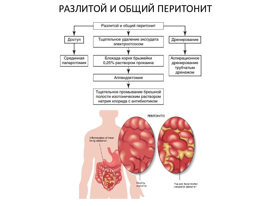 Перитонит у детей презентация