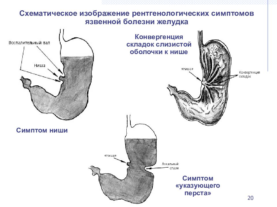 Признаки язвы желудка симптомы. Рентген язвы желудка симптом ниши. Язва малой кривизны тела желудка схема. Язва малой кривизны желудка схема. Ниша желудка рентген язвенная.