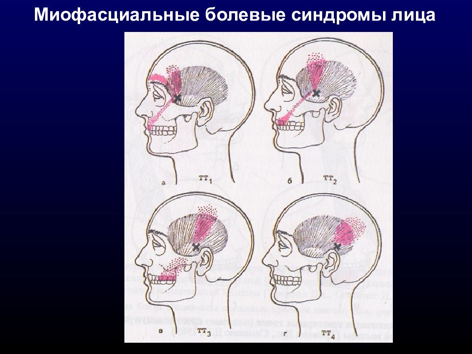 Миофасциальный болевой синдром. Миофасциальный синдром ЧЛХ. Миофасциальный болевой синдром неврология. Миофасциальный болевой синдром ЧЛХ.