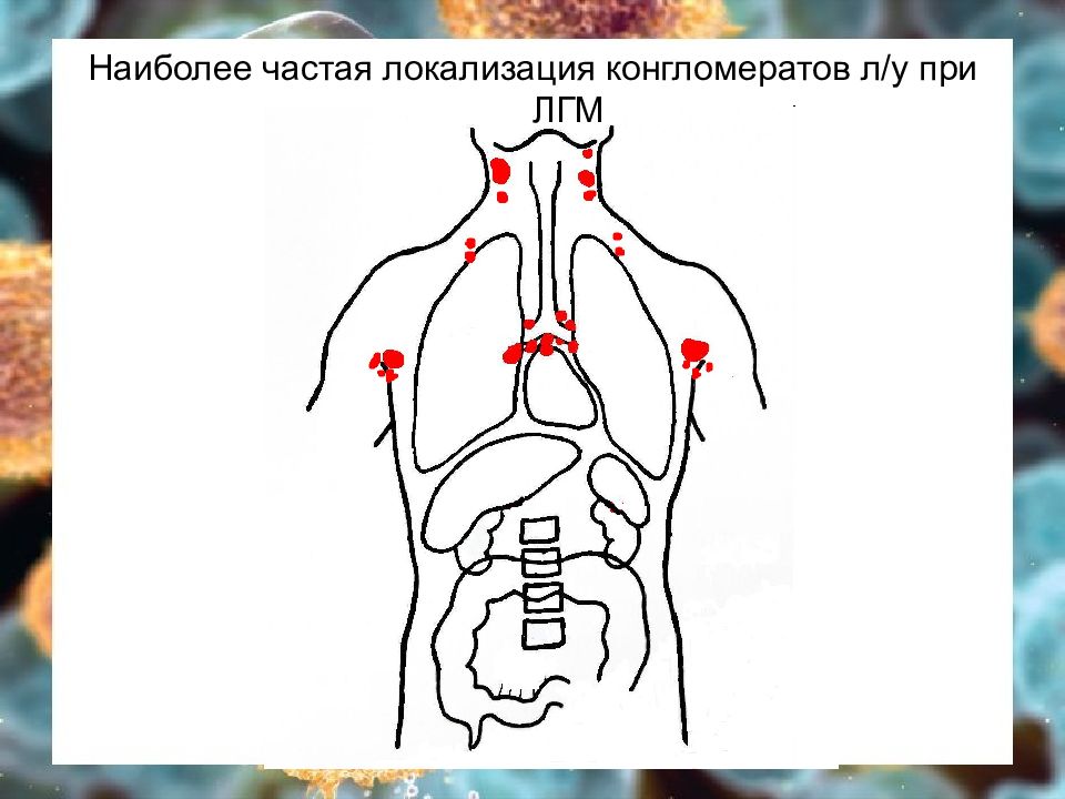 Наиболее частой локализацией. Конгломерат лимфатических узлов. Причины конгломерата лимфоузлов. Лимфоузлы в виде конгломератов. Лимфоузлы по типу конгломерат.