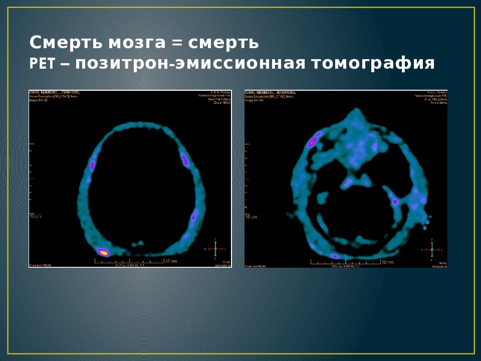 Сколько может прожить мозг. Смерть мозга. Смерть мозга исследование. Клиническая смерть мозга. Смерть головного мозга понятие.