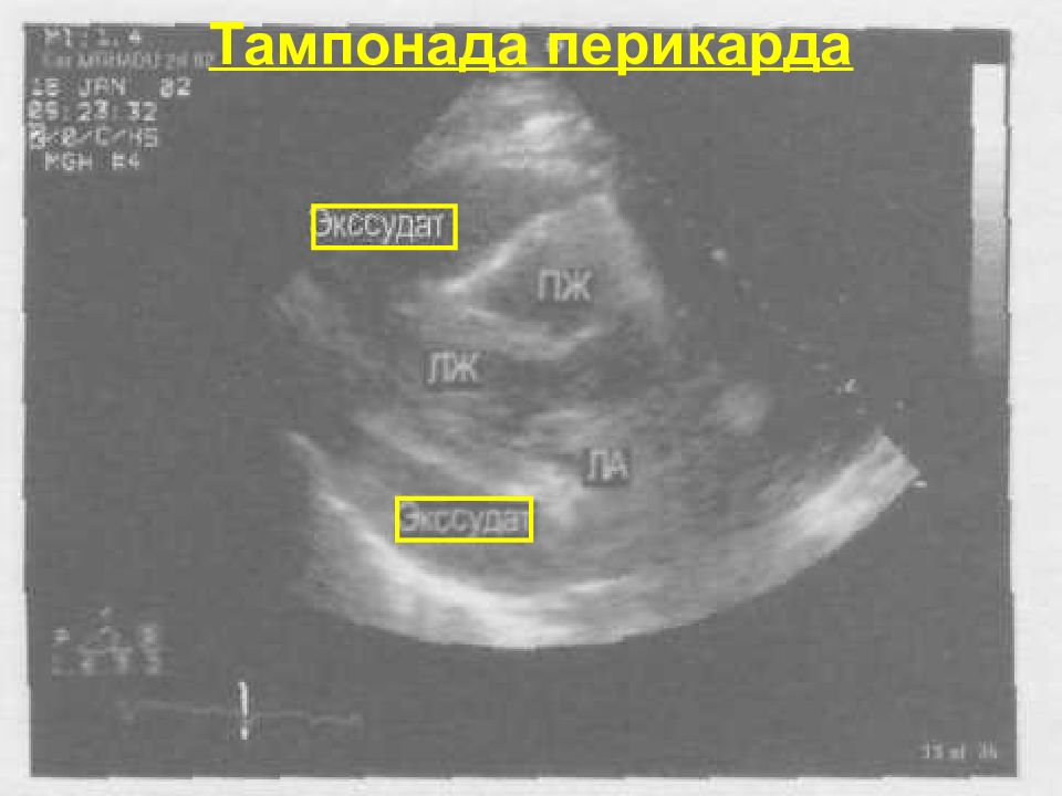 Жидкость в перикарде. Гидроперикард на ЭХОКГ. УЗИ признаки тампонады сердца. Тампонада сердца на ЭХОКГ.