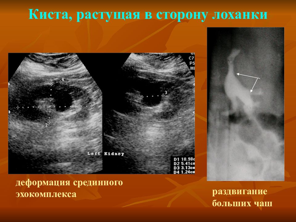 Киста правой почки. Киста в почечной лоханке. Киста лоханки почки на УЗИ.