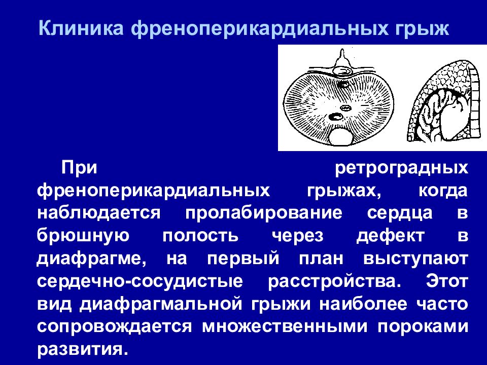 Диафрагмальные грыжи у детей презентация