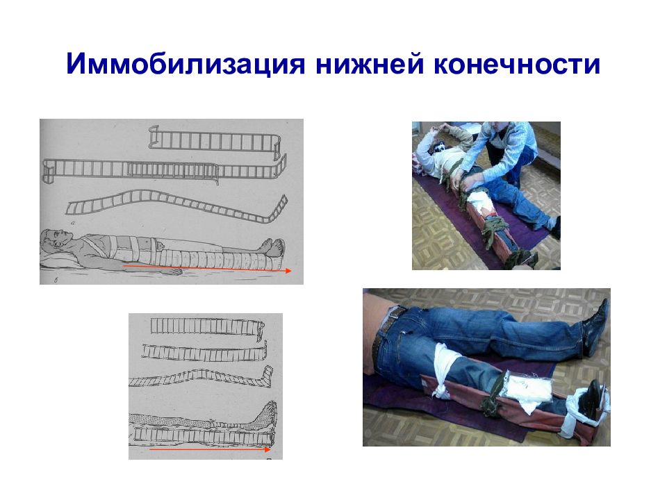 Иммобилизация травмированной конечности. Травмы опорно-двигательного аппарата иммобилизация. 2.3 Транспортная иммобилизация принципы. Иммобилизация конечности. Мобилизация нижних конечностей.