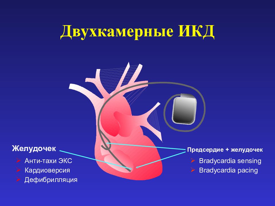 Экс что это. Имплантируемый кардиовертер-дефибриллятор. Кардиовертер-дефибриллятор имплантируемый двухкамерный. Имплантируемый кардиовертер-дефибриллятор (ИКД). Имплантируемые кардиовертеры-дефибрилляторы (ИКД).