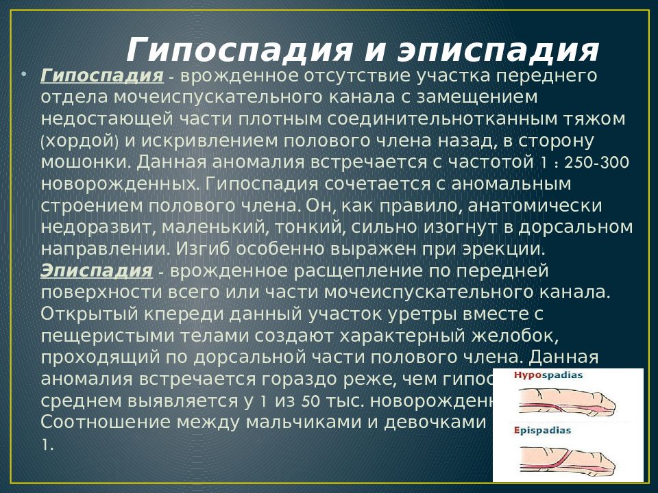 Гипоспадия это. Гипоспадия искривление. Гипоспадия полового члена. Гипоспадия презентация. Гипоспадия у детей классификация.