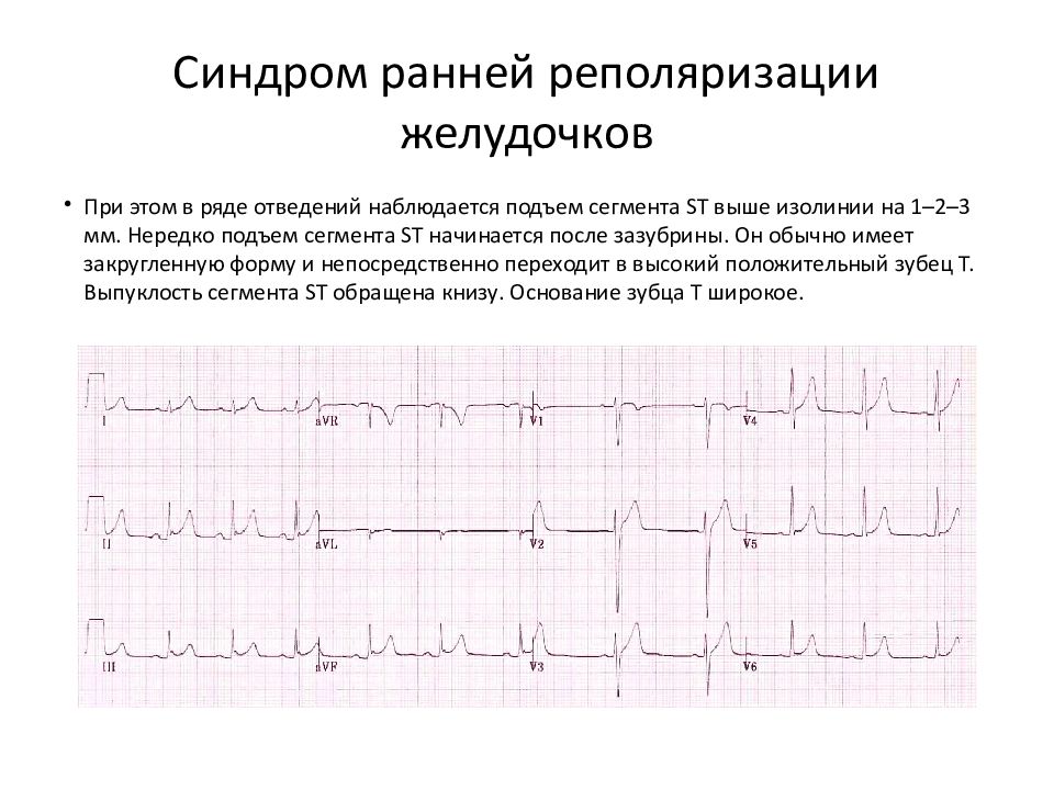 Изменение процессов реполяризации лж. Ранняя реполяризация на ЭКГ. Синдром ранней реполяризации желудочков на ЭКГ. Феномен ранней реполяризации желудочков. Ранняя реполяризация желудочков на ЭКГ.