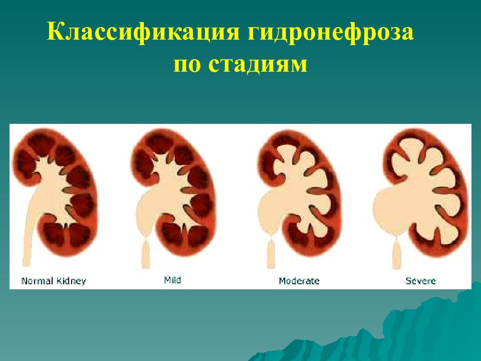 Гидронефроз клиническая картина