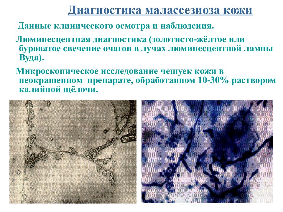 Диагноз кожи. Диагностика малассезиоза. Микроскопического исследования чешуек. Микоз кожи микроскопия.