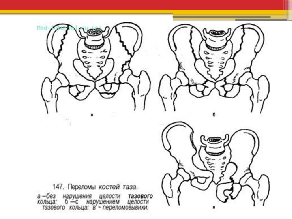 Переломы таза травматология презентация