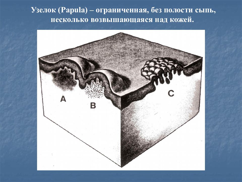Папула элемент. Папула элемент