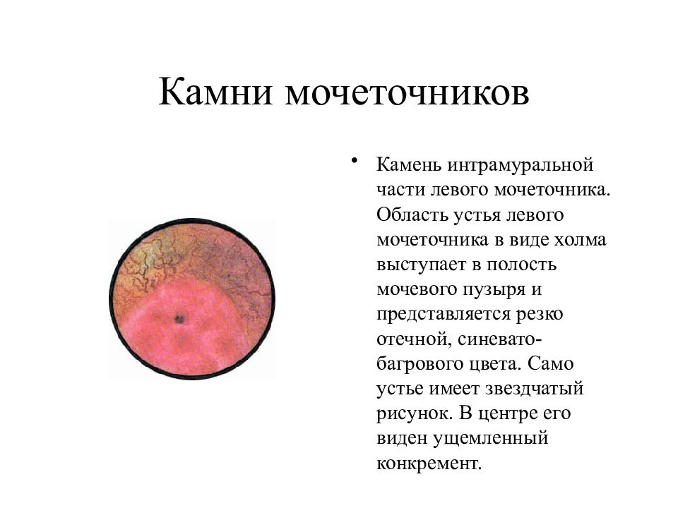 Камень левого мочеточника. Устью мочетонника камень. Конкремент устья мочеточника. Камень в Устье мочеточника 5 мм. Камень в мочеточнике Устье 6 мм.