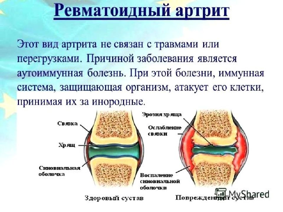 История ревматоидного артрита. Формы ревматоидного артрита. Суставы при ревматоидном артрите. Жалобы при ревматоидном артрите.