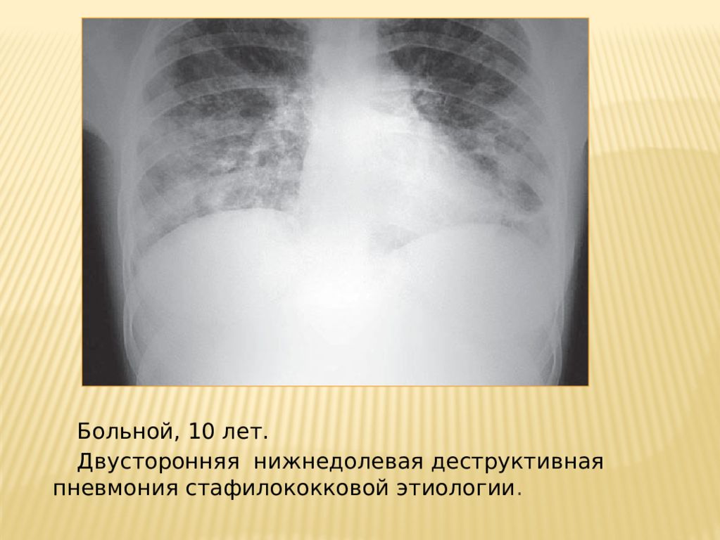 Двусторонняя пневмония. Двусторонняя нижнедолевая пневмония. Нижнедолевая полисегментарная пневмония. Острая деструктивная пневмония у детей рентген. Двусторонняя нижнедолевая пневмония рентген.