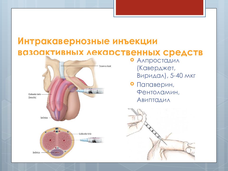Папаверин инъекции. Интракавернозные инъекции. Интракавернозное Введение препаратов. Введение интракавернозной инъекции. Интракавернозное Введение папаверина.