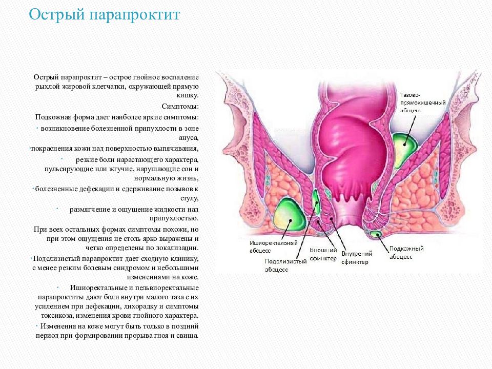 Парапроктит больница