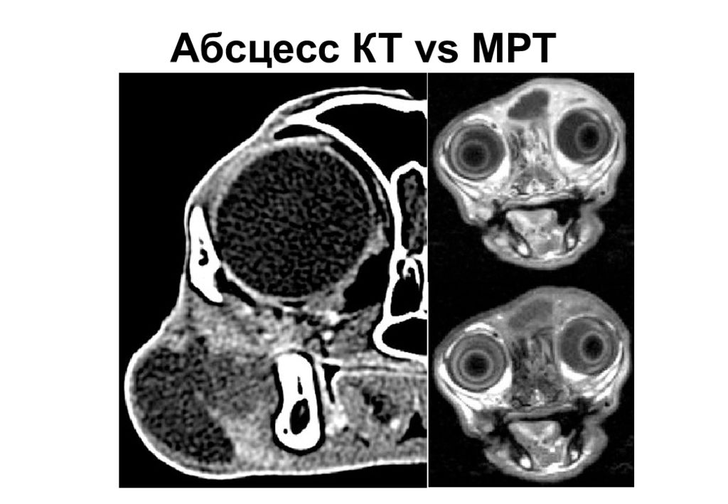 Абсцесс на мрт. Компьютерная томография лицевого отдела черепа. Абсцесс мягких тканей мрт. Абсцесс мягких тканей на кт.