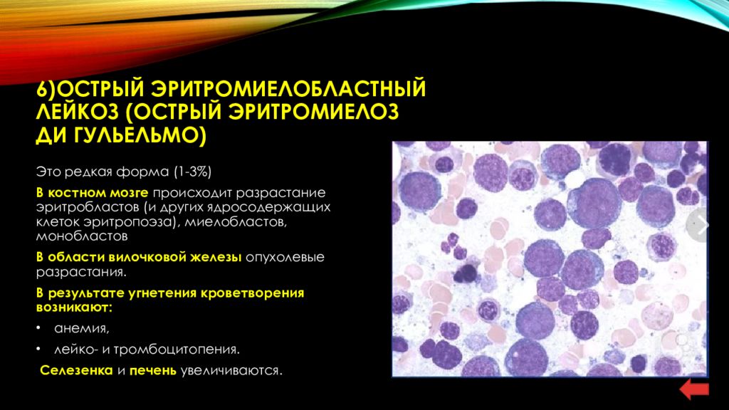 Бензольный лейкоз презентация