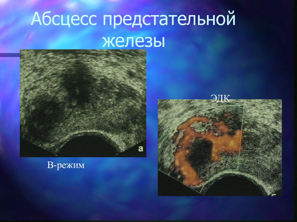 Абсцесс простаты. Абсцесс предстательной железы. Дренирование абсцесса предстательной железы. Абсцесс предстательной железы УЗИ. Признаки абсцесса предстательной железы.