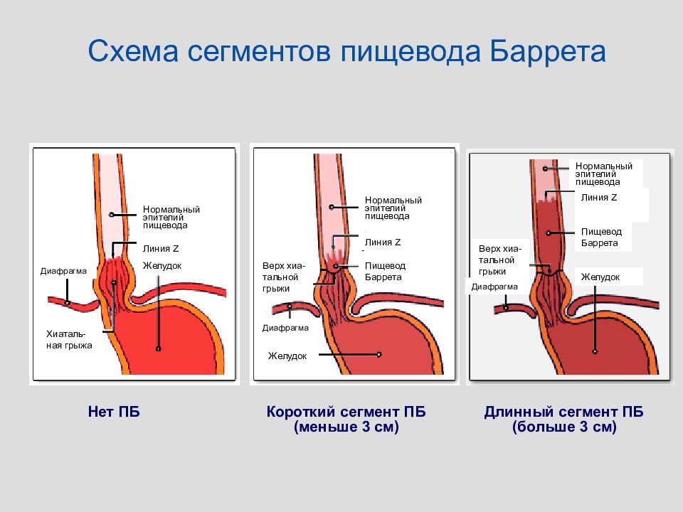 Кольцо шацкого в пищеводе что это. Классификация пищевода Барретта эндоскопия. Заболевание пищевод Баррета. Z-линия и пищеводно желудочного перехода.