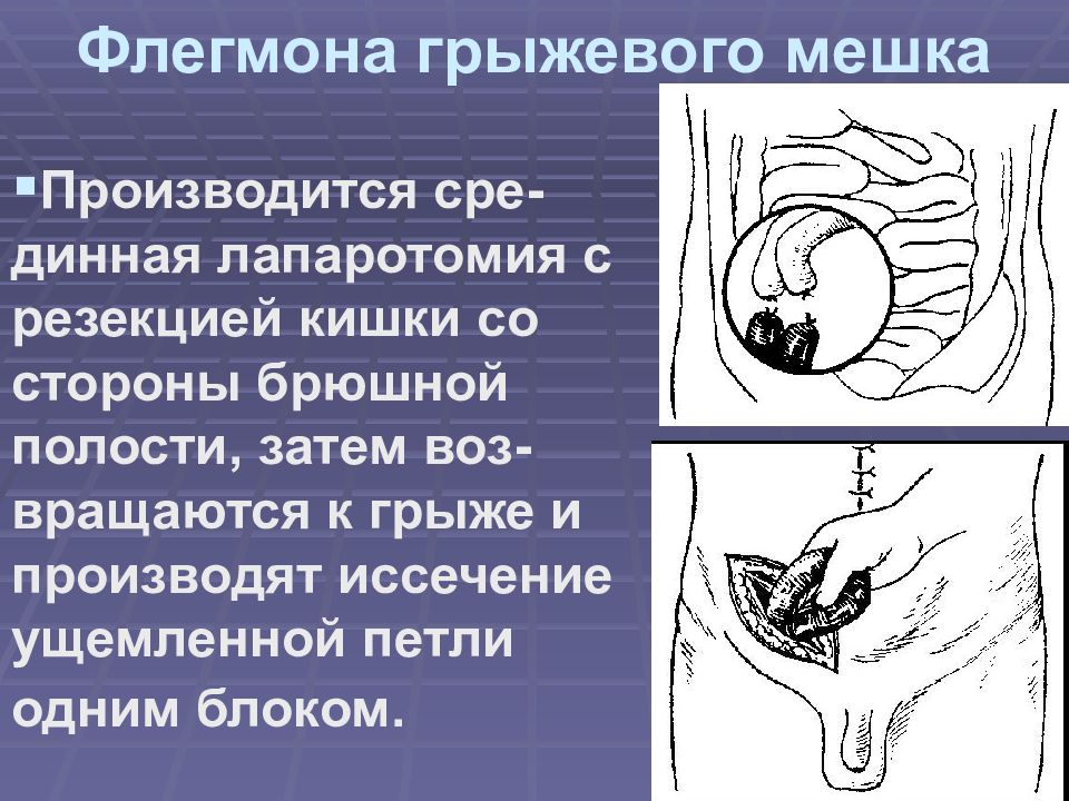 Грыжи живота госпитальная хирургия презентация