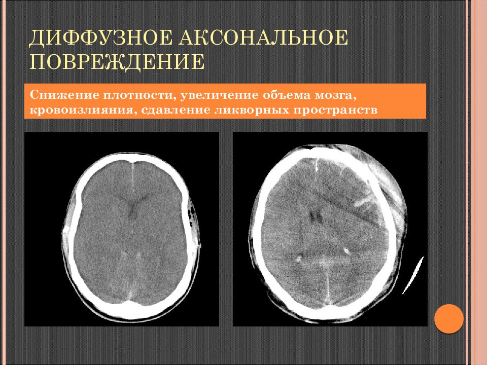 Диффузное снижение плотности. Аксональное повреждение головного мозга на кт. Диффузное аксональное повреждение кт. Диффузное аксональное повреждение головного мозга кт. Диффузное аксональное повреждение мрт.